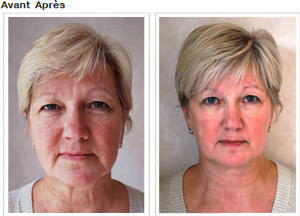 Slendertone Face